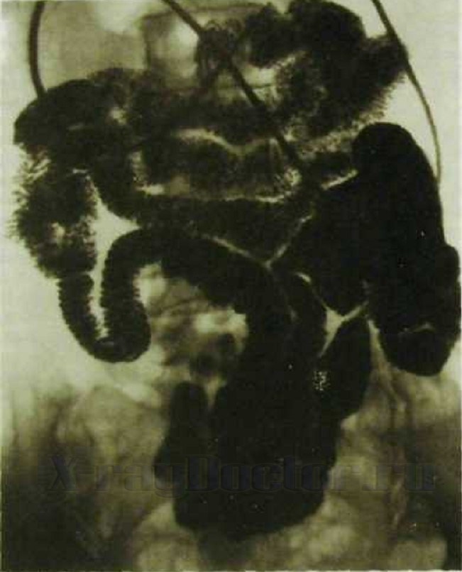 фото рентгена кишечника
